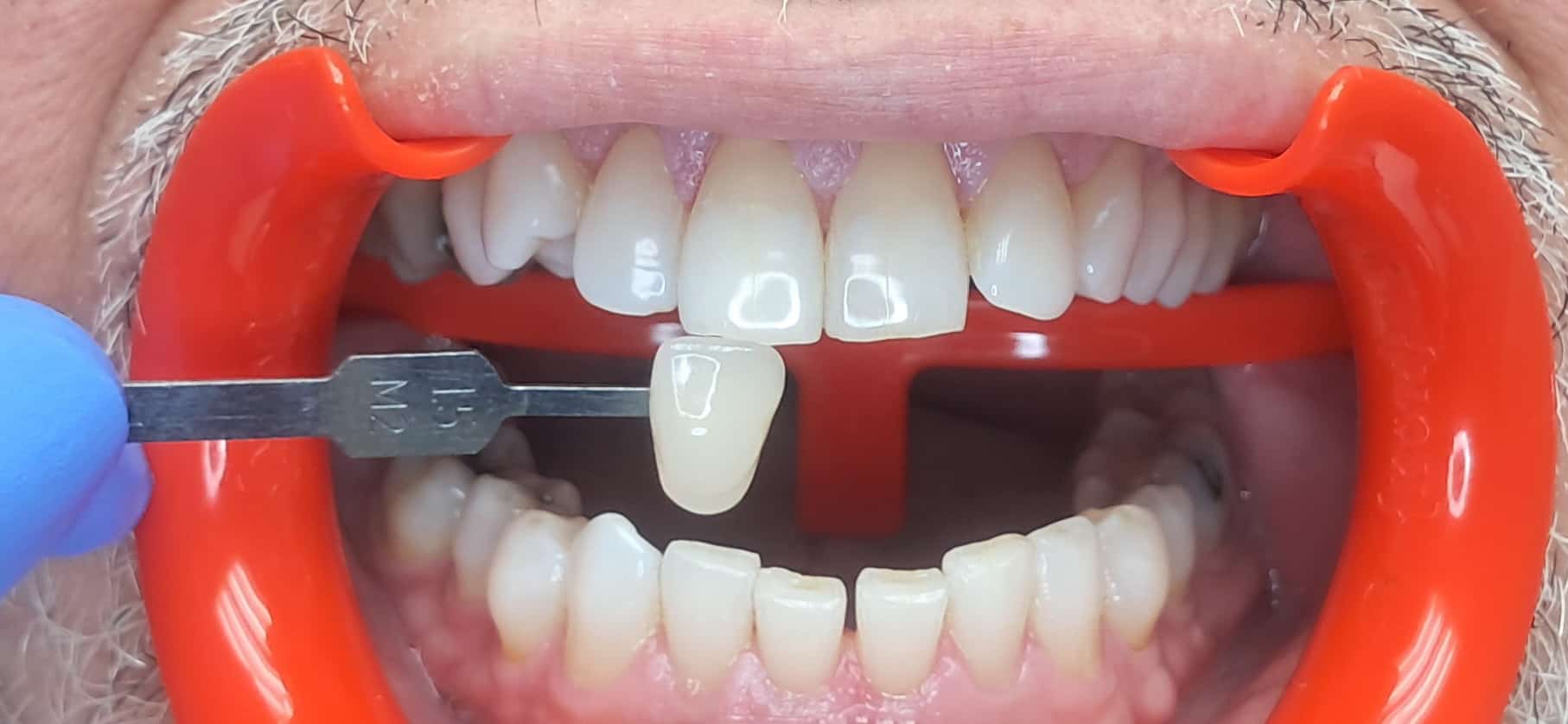 Teeth Whitening